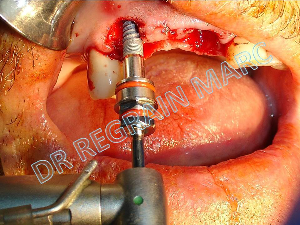 Placing the implant with contra angle