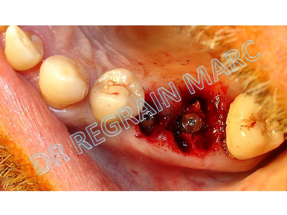 Dental implant placing Implementation exctration